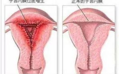 子宫内膜增厚的症状,症状解析与自我识别指南