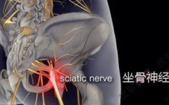 坐骨神经痛的原因,从原发性到继发性病因全面剖析