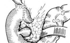 十二指肠憩室,成因、症状与诊断治疗概述